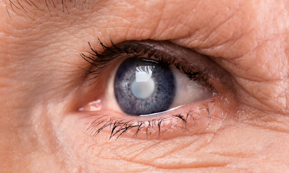 Cataract Cataract