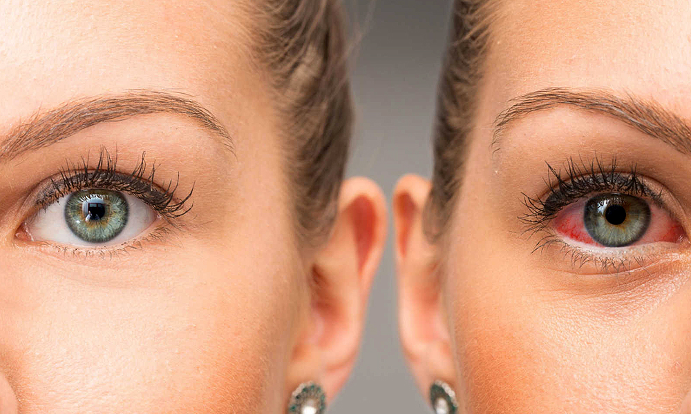 Glaucoma Glaucoma